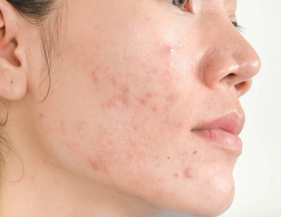 Acne